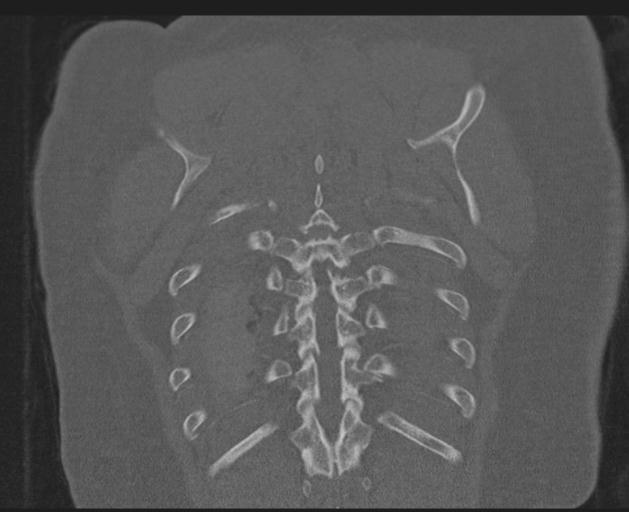 Burst fracture - thoracic spine (Radiopaedia 30238-30865 Coronal bone window 141).jpg