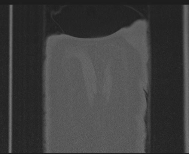 Burst fracture - thoracic spine (Radiopaedia 30238-30865 Coronal bone window 162).jpg