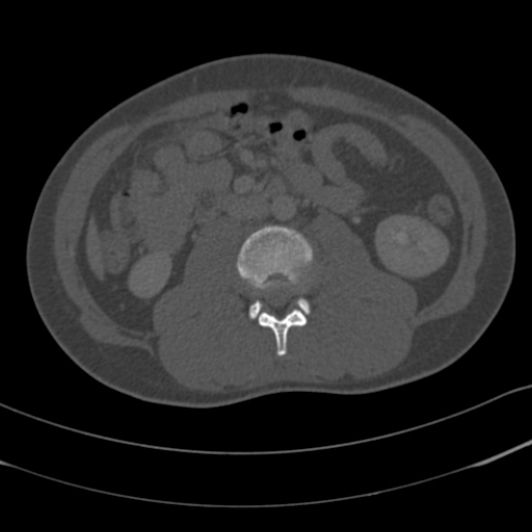 Burst fracture with cauda equina syndrome (Radiopaedia 25701-25867 Axial bone window 71).jpg