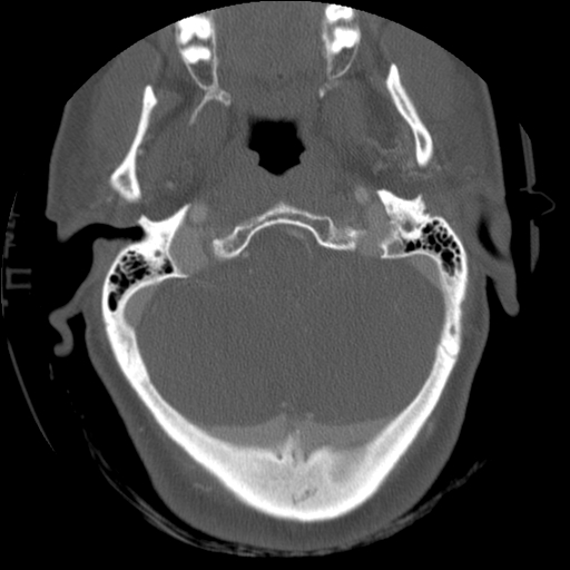 File:C1 anterior arch (plough) fracture - type 1 (Radiopaedia 76181-87720 Axial bone window 21).jpg