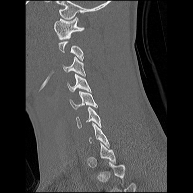 C5 facet fracture (Radiopaedia 58374-65499 Sagittal bone window 27).jpg