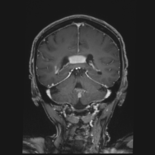 CNS lymphoma with steroid response (Radiopaedia 37980-39921 Coronal T1 C+ 31).png