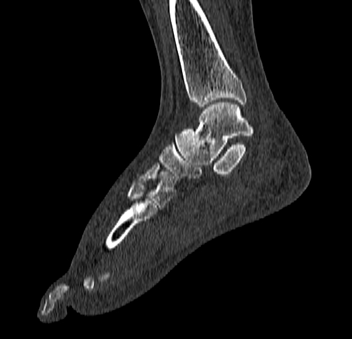 Calcaneal fracture - Sanders type 4 (Radiopaedia 90179-107370 Sagittal bone window 44).jpg