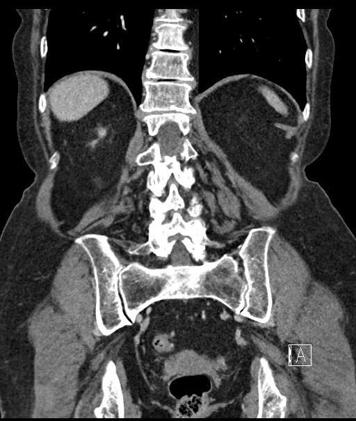 Calcified adrenal glands and Spigelian hernia (Radiopaedia 49741-54988 B 87).jpg