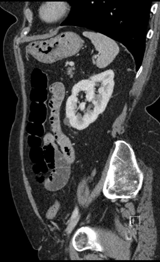 Calcified adrenal glands and Spigelian hernia (Radiopaedia 49741-54988 C 45).jpg