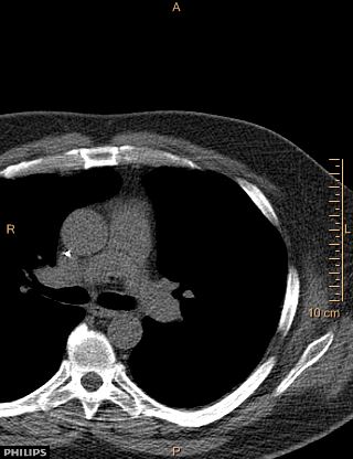 File:Calcified cardiac fibroma (Radiopaedia 39267-41519 Axial non-contrast 2).jpg