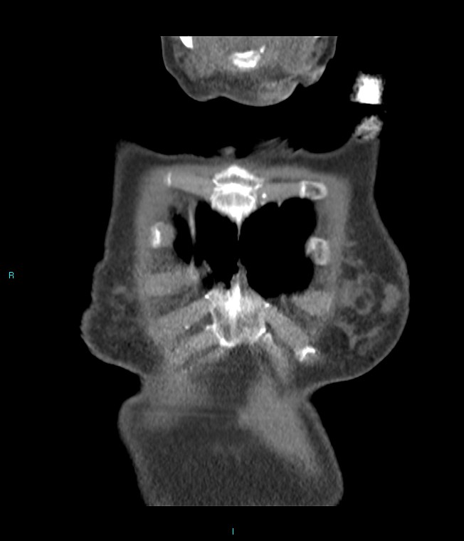 Calcified cerebral emboli from left ventricular thrombus (Radiopaedia 84420-99760 Coronal C+ CTPA 67).jpg