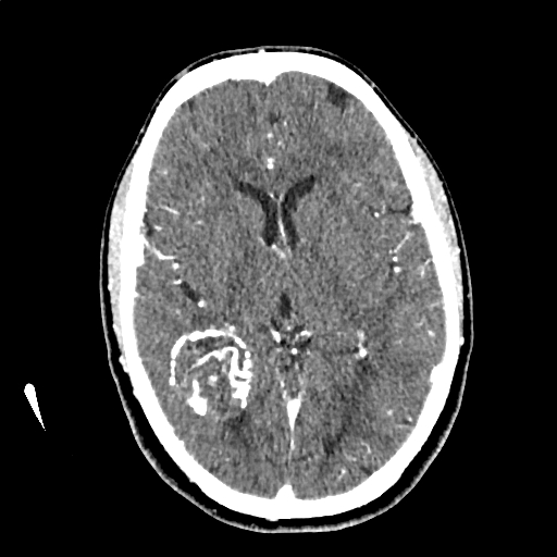 Calcified cerebral hydatid cyst (Radiopaedia 65603-74717 Axial with contrast 37).jpg