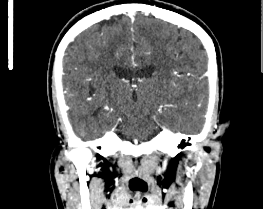Calcified cerebral hydatid cyst (Radiopaedia 65603-74717 C 39).jpg