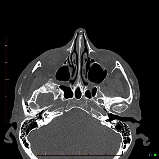 Calcified facial augmentation fillers (Radiopaedia 79514-92679 Axial bone window 6).jpg