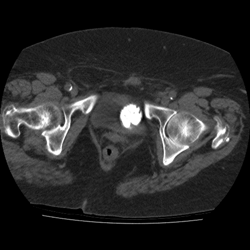 File:Calcified fibroids (Radiopaedia 16853-16579 non-contrast 15).jpg