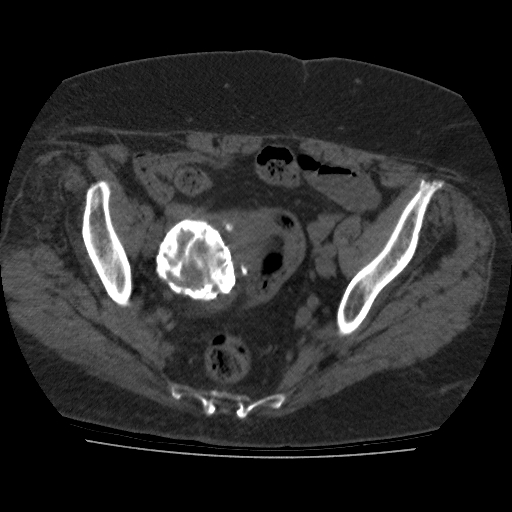 File:Calcified fibroids (Radiopaedia 16853-16579 non-contrast 5).jpg