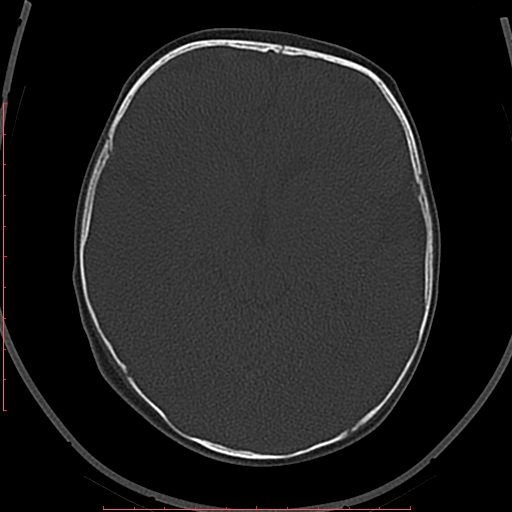 Calcified middle cerebral artery embolism (Radiopaedia 78949-91860 Axial bone window 27).jpg