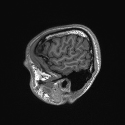 Callosal dysgenesis with interhemispheric cyst (Radiopaedia 53355-59335 Sagittal T1 154).jpg