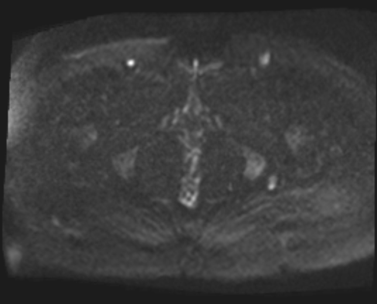 Cancer cervix - stage IIb (Radiopaedia 75411-86615 Axial DWI 60).jpg