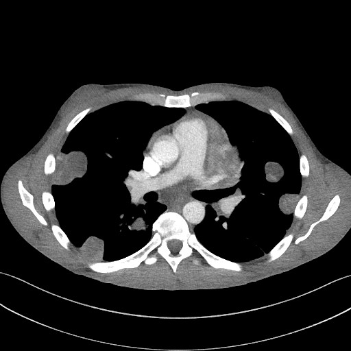 File:Cannonball metastases - testicular choriocarcinoma (Radiopaedia 84510-99891 B 58).jpg