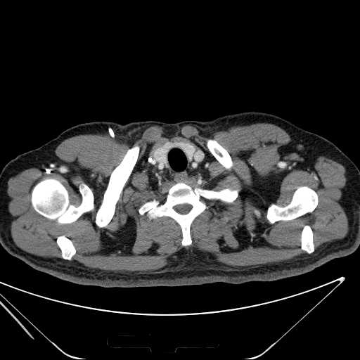 File:Cannonball pulmonary metastases (Radiopaedia 67684-77101 D 11).jpg