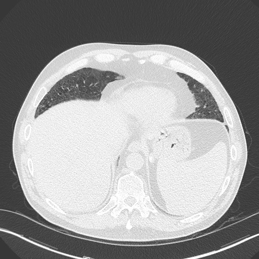 Caplan syndrome (Radiopaedia 56667-63530 Axial lung window 159).jpg