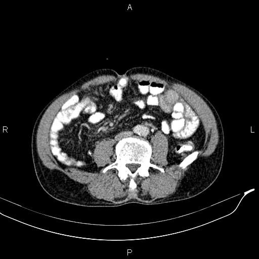 Caput medusae sign - portal hypertension (Radiopaedia 64007-72759 A 58).jpg