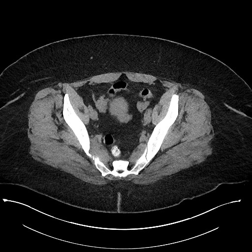 File:Carcinoid tumor - terminal ileum (Radiopaedia 60931-68740 Axial non-contrast 101).jpg