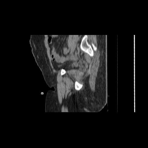 File:Carcinoma cervix- brachytherapy applicator (Radiopaedia 33135-34173 D 44).jpg