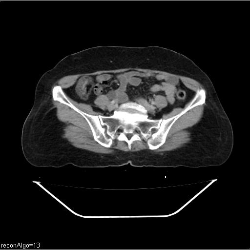 File:Carcinoma cervix- recurrence (Radiopaedia 34702-36137 B 38).jpg