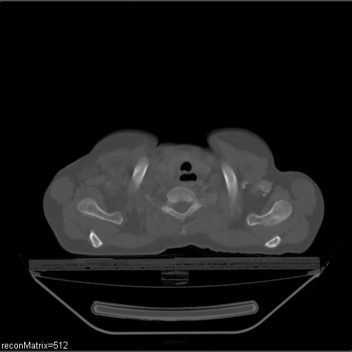 File:Carcinoma of esophagus (Radiopaedia 27356-27550 Axial bone window 31).jpg