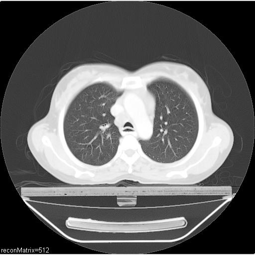 File:Carcinoma of esophagus (Radiopaedia 27356-27550 Axial lung window 23).jpg