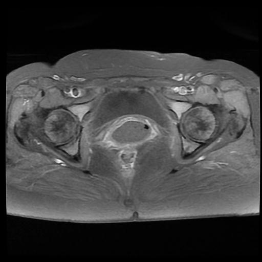 File:Carcinoma of the cervix (Radiopaedia 89018-105858 Axial T1 C+ fat sat 13).jpg