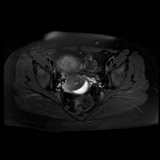 File:Carcinoma of the cervix (Radiopaedia 89018-105858 Axial T2 fat sat 9).jpg
