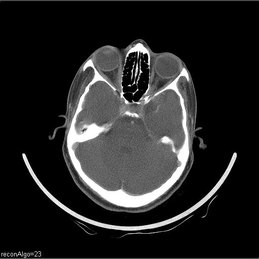 File:Carcinoma of the maxillary antrum (Radiopaedia 53805-59888 Axial C+ delayed 66).jpg