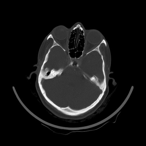 Carcinoma of the maxillary antrum (Radiopaedia 53805-59888 Axial bone window 22).jpg