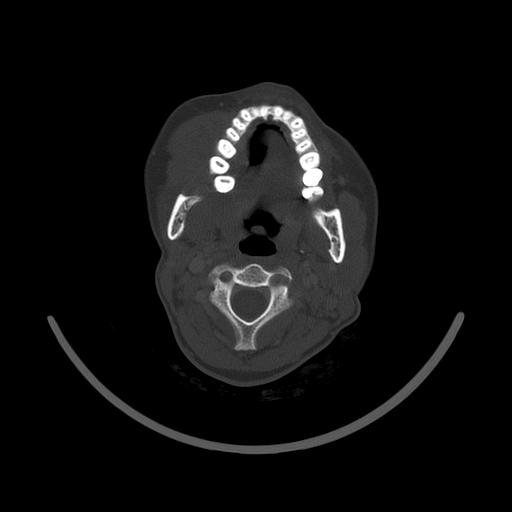 Carcinoma of the maxillary antrum (Radiopaedia 53805-59888 Axial bone window 84).jpg