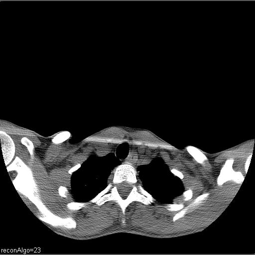 Carcinoma of the maxillary antrum (Radiopaedia 53805-59888 Axial non-contrast 4).jpg
