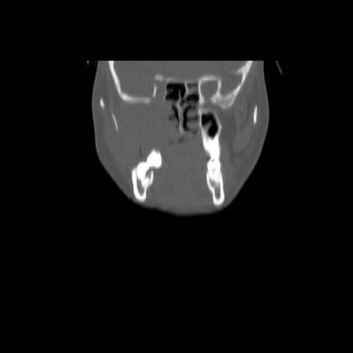 Carcinoma of the maxillary antrum (Radiopaedia 53805-59888 Coronal bone window 50).jpg
