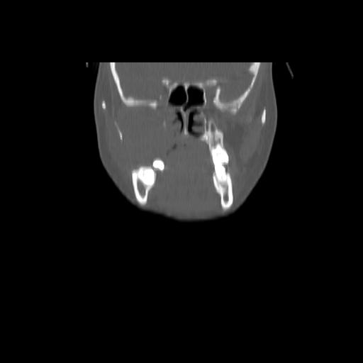 Carcinoma of the maxillary antrum (Radiopaedia 53805-59888 Coronal bone window 53).jpg