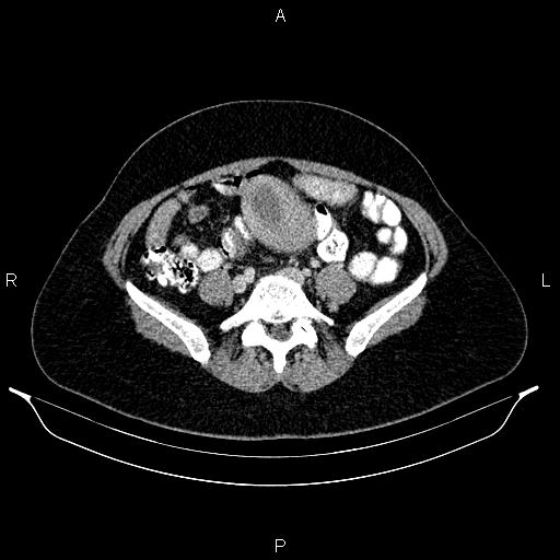 Carcinoma of uterine cervix (Radiopaedia 85861-101700 A 59).jpg