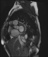 Cardiac amyloidosis (Radiopaedia 51404-57150 Sagittal CINE SSFP 272).jpg