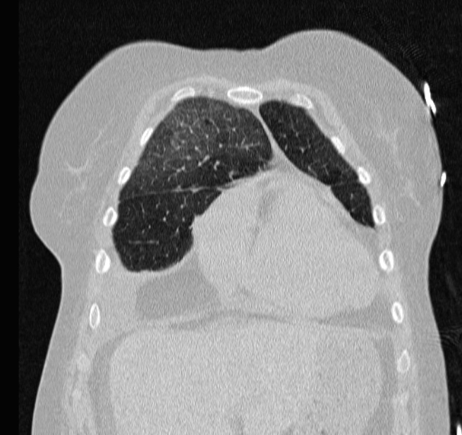Cardiogenic pulmonary edema (Radiopaedia 29213-29609 Coronal lung window 13).jpg