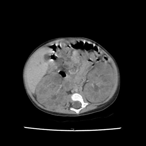 Caroli disease with autosomal recessive polycystic kidney disease (ARPKD) (Radiopaedia 89651-106703 B 117).jpg