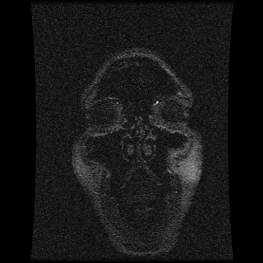 File:Carotid arterial dissection with acute cerebral infarction (Radiopaedia 26636-26784 MRV 146).jpg