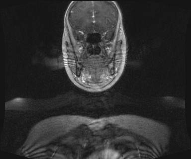 Carotid body tumor (Radiopaedia 12777-12912 MRA 10).jpg