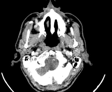 Carotid body tumor (Radiopaedia 61750-69757 Axial Post contrast 3).jpg
