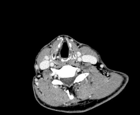 Carotid body tumor (Radiopaedia 61750-69757 Axial Post contrast 79).jpg
