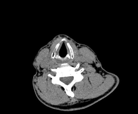Carotid body tumor (Radiopaedia 61750-69757 Axial non-contrast 75).jpg