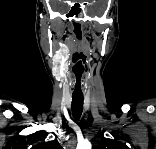 File:Carotid body tumor (Radiopaedia 83615-98727 B 55).jpg