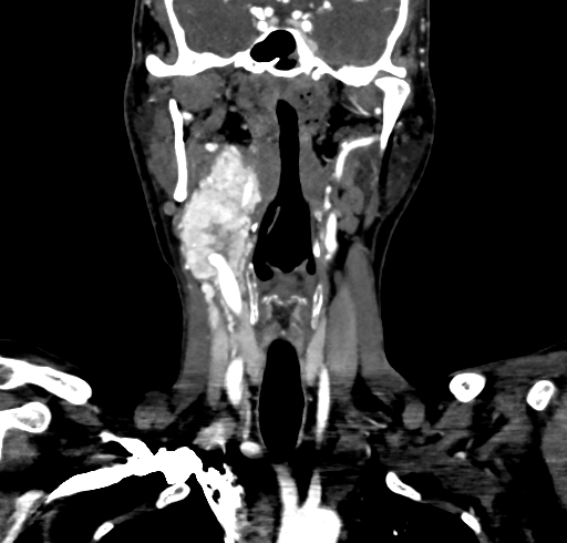 File:Carotid body tumor (Radiopaedia 83615-98727 B 60).jpg