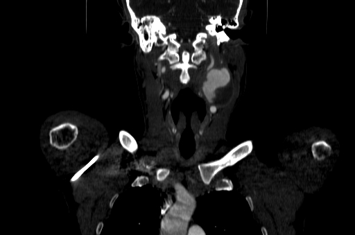 File:Carotid bulb pseudoaneurysm (Radiopaedia 57670-64616 D 23).jpg