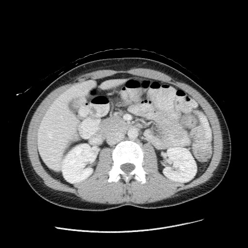 Castleman disease with fibrous pseudotumor in the abdomen (Radiopaedia 77296-89373 A 52).jpg