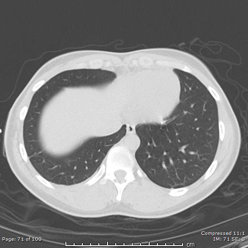 Catamenial pneumothorax (Radiopaedia 54382-60600 Axial non-contrast 71).jpg